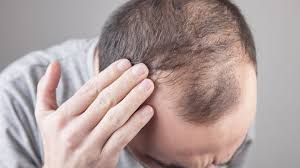 hair loss after bariatric surgery what