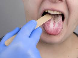 yeast infection in mouth causes
