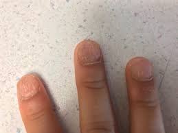 fingernail dystrophy in a young child