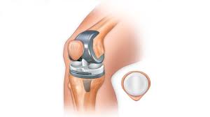 knee replacement treatments