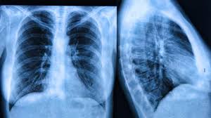 Pulmonary fibrosis is a disease caused by scarring in the lungs. Fibrosis Quistica La Enfermedad Rara Cronica Que Afecta A Varios Organos Infobae