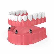 permanent dentures the pros and cons