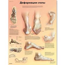 Deformities Of The Feet Chart
