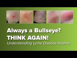 think the lyme disease rash is always a