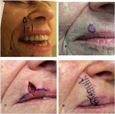 basal cell carcinoma a patient and
