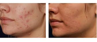 smoothbeam vbeam laser for acne