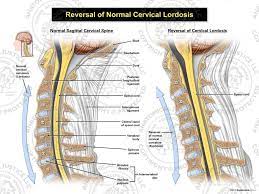 cervical lordosis ilration