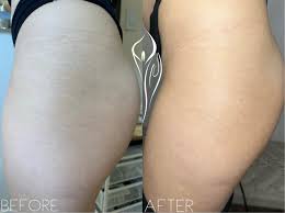 stretch marks reduction askcares
