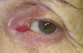 lacrimal infections boise