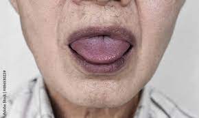cyanotic lips or central cyanosis at