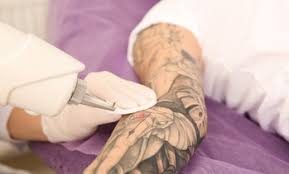 portland tattoo removal deals in and