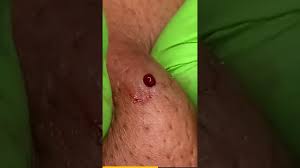 shocking cyst removal part 10 must
