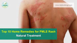 top 10 home remes for pmle rash