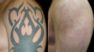 There are numerous tattoo removal methods without laser usage. How To Remove Tatoo Easily Methods For Remove A Tattoo