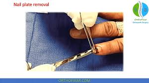 nail bed repair 2023 orthofixar