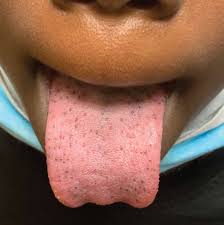 hyperpigmented pas on the tongue of