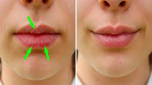 best dry chapped lips treatment in delhi