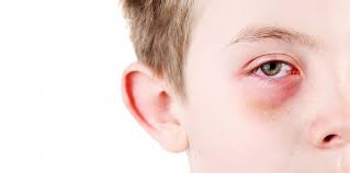 how do i know if my child has pink eye