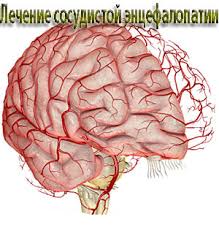 Энцефалопатия — это общее название невоспалительных болезней головного мозга. Lechenie Discirkulyatornoj Encefalopatii