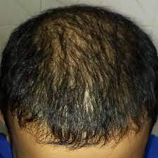 can dead hair follicles regrow by prp