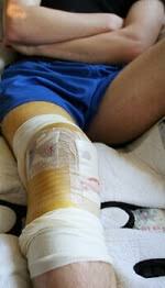 recovery after acl surgery knee pain