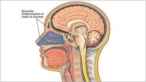 home remes for sinus infection