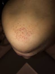 help weird rash under chin babycenter