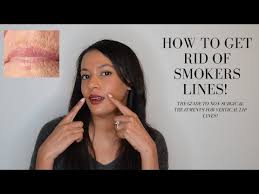 botox treatment for lip lines smoker s