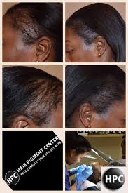 scalp tattooing for black women a