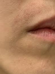 hyperpigmentation upper lip
