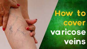 cover varicose veins spider veins