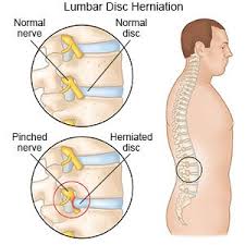 lumbar disc herniation what you need