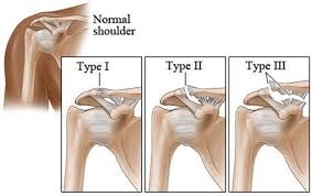 The ligament has sustained mild damage and been slightly stretched but can still keep the knee joint stable. Shoulder Sprains Orthopedic Surgeon Dr Lawrence Li Md At The Orthopedic And Shoulder Center