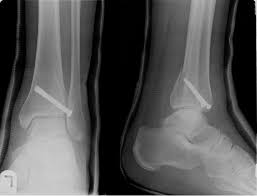 Maisonneuve fracture is a fracture of the proximal third of the fibula resulting from forced external rotation of the foot.1 many authors consider maisonneuve injury to be one of the most unstable. Figure 3 From Report Of The Case Of A Rare Pattern Of Maisonneuve Fracture Semantic Scholar