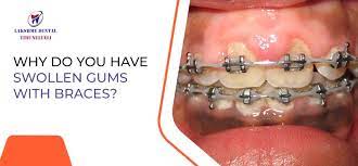 why do you have swollen gums with braces