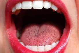 what should i know about dry mouth