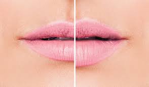 dissolving lip filler a guide to lip