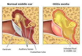 Patient Education Ear Infections Otitis Media In Children