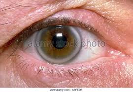 The viral variety is like a. What Does It Mean If You Have A White Ring Around Your Eye Quora