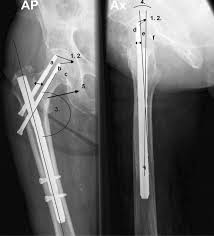 trochanteric femur fractures