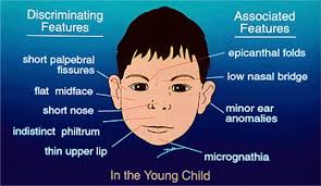 Down syndrome had been suspected in some of the patients. Fetal Alcohol Spectrum Disorders Paediatrics And Child Health