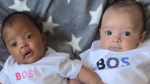 mum of unique twins born with diffe
