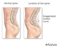 Image result for icd 10 code for lordosis lumbar region