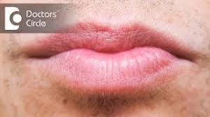 white spots on lips causes pictures