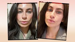 lip lift surgery