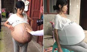 Chinese woman's belly grows to 44lbs due to mystery condition | Daily Mail  Online