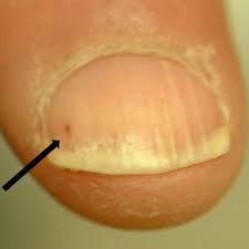 psoriatic arthritis nail symptoms 6