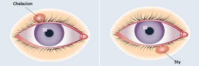 minor ophthalmic surgeries cover
