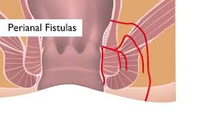 fistula johns hopkins cine