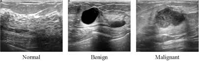 The usual indication for an ultrasound for breast cancer would be a suspicious finding. Dataset Of Breast Ultrasound Images Sciencedirect